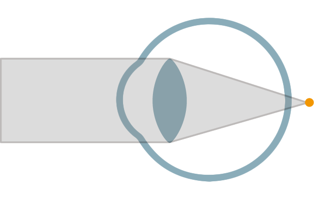 hyperopia_1.png hyperopia_1.png