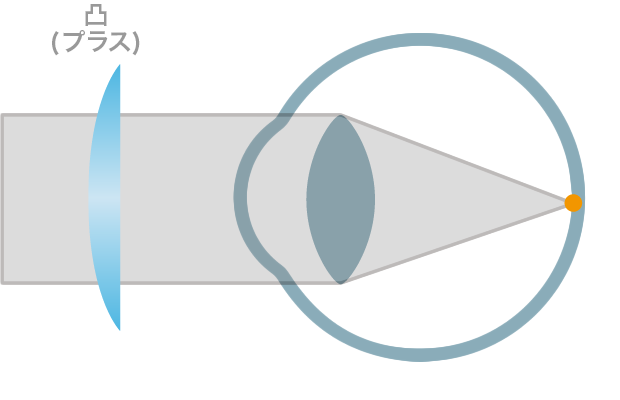 hyperopia_2.png hyperopia_2.png