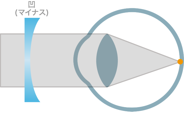 myopia_2.png myopia_2.png