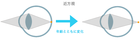 presbyopia_1.png presbyopia_1.png