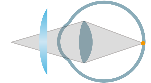 presbyopia_2.png presbyopia_2.png